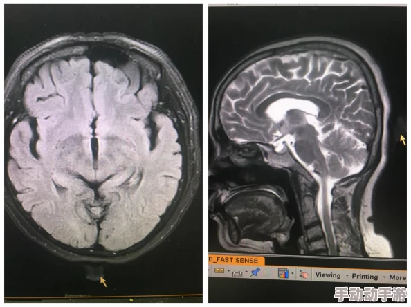 黄色综合症误诊率高延误治疗或致病情恶化带来严重后果